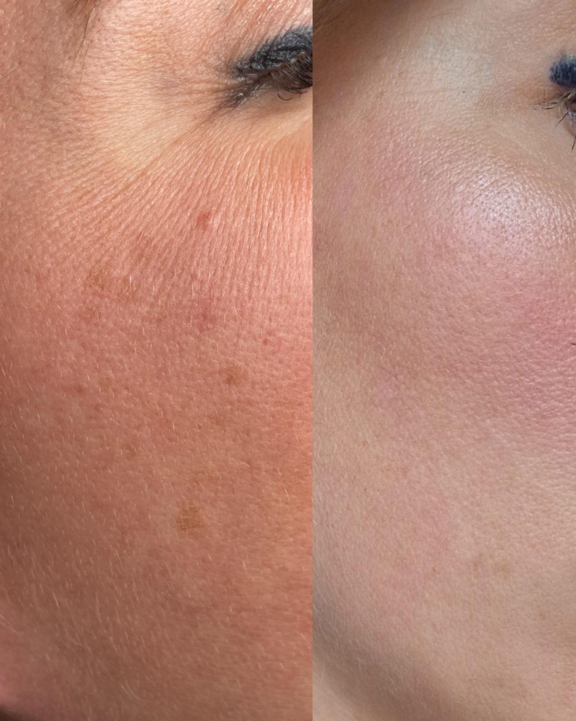 pigmentvlekken laseren